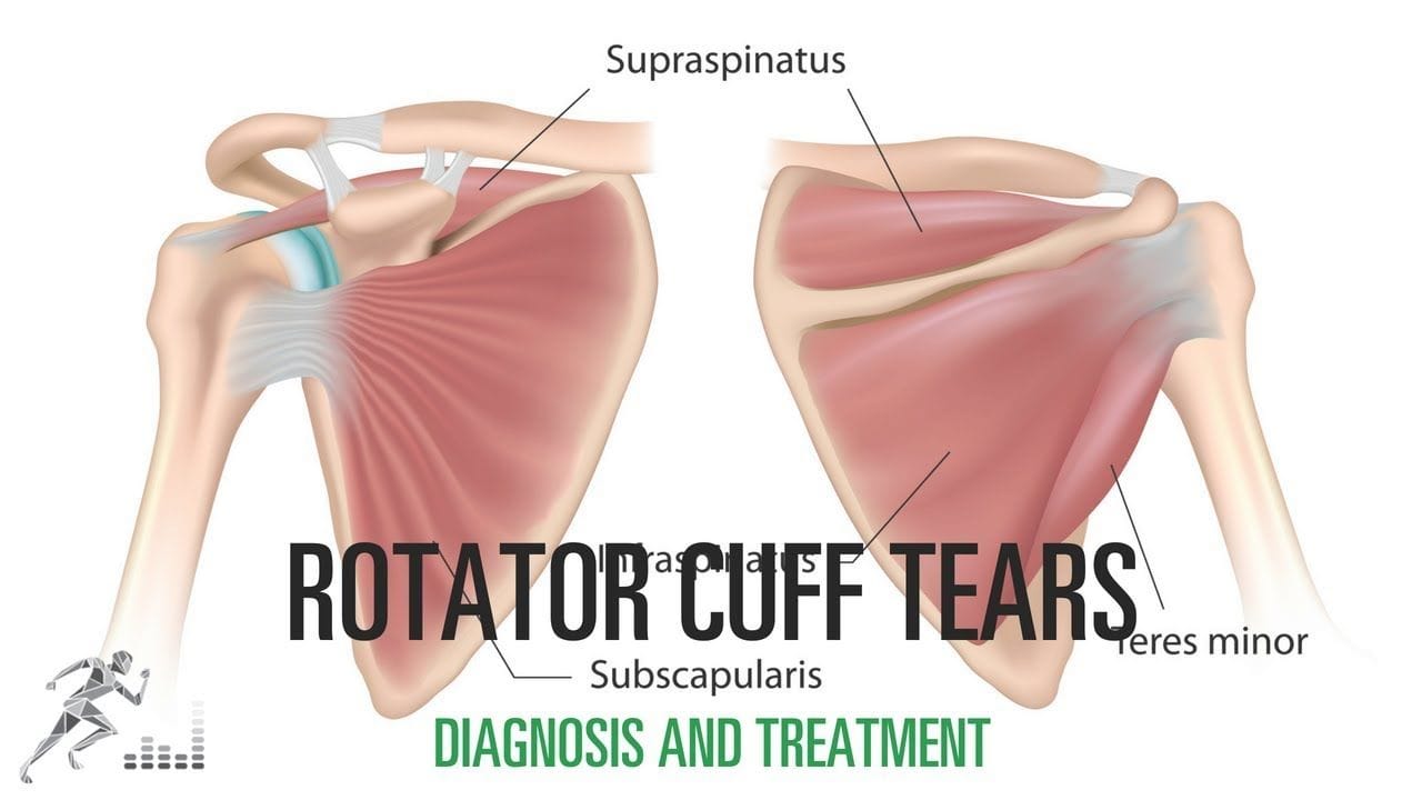 Managing Rotator Cuff Injuries